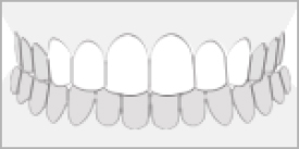 セラミック矯正 前歯6本